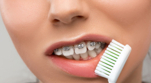 矯正歯科治療中のアドバイス