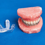 矯正歯科治療の種類（表、裏、マウスピースを紹介）