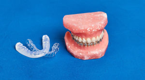 矯正歯科治療の種類（表、裏、マウスピースを紹介）