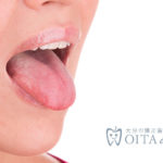 舌が短い？舌小帯短縮症とは