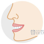 下顎前突（受け口・しゃくれ）