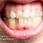 そう生とは（歯がデコボコな歯並び）