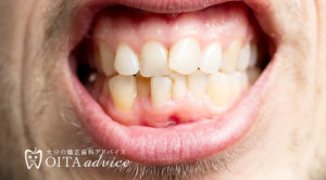 そう生とは（歯がデコボコな歯並び）