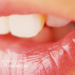 出っ歯の症状と治療方法