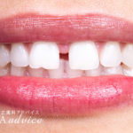 開咬（前歯が閉じない）