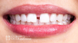 開咬（前歯が閉じない）