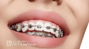 矯正歯科治療のリスク