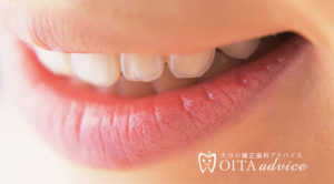 過蓋咬合（かみ合わせが深い）